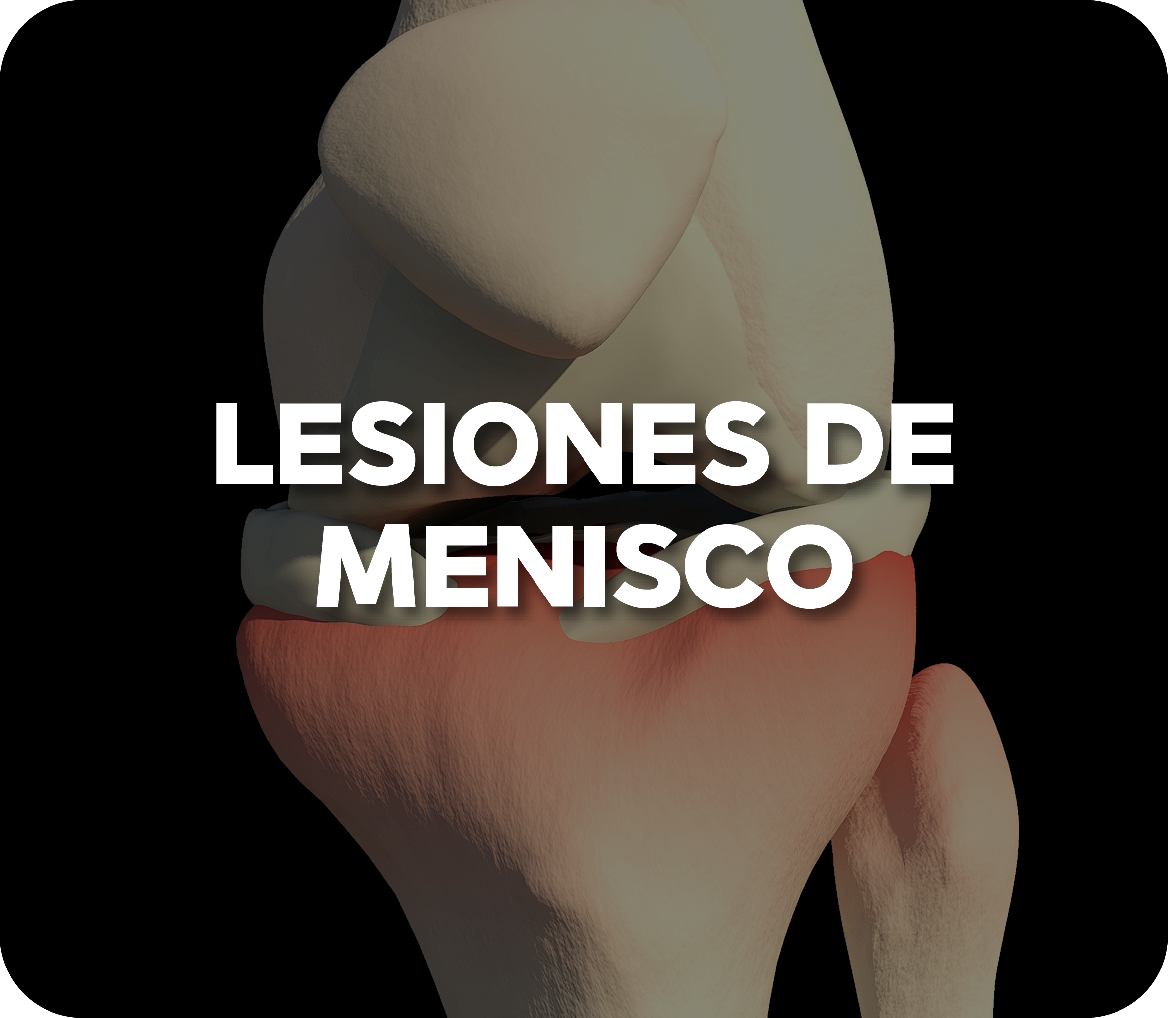 Luxación de hombro